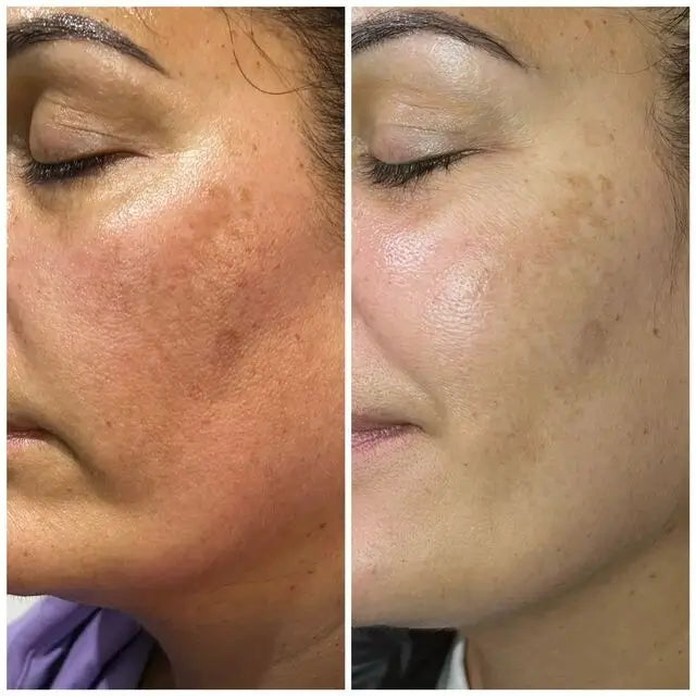„Dermalux LED“ fototerapija (30 min)